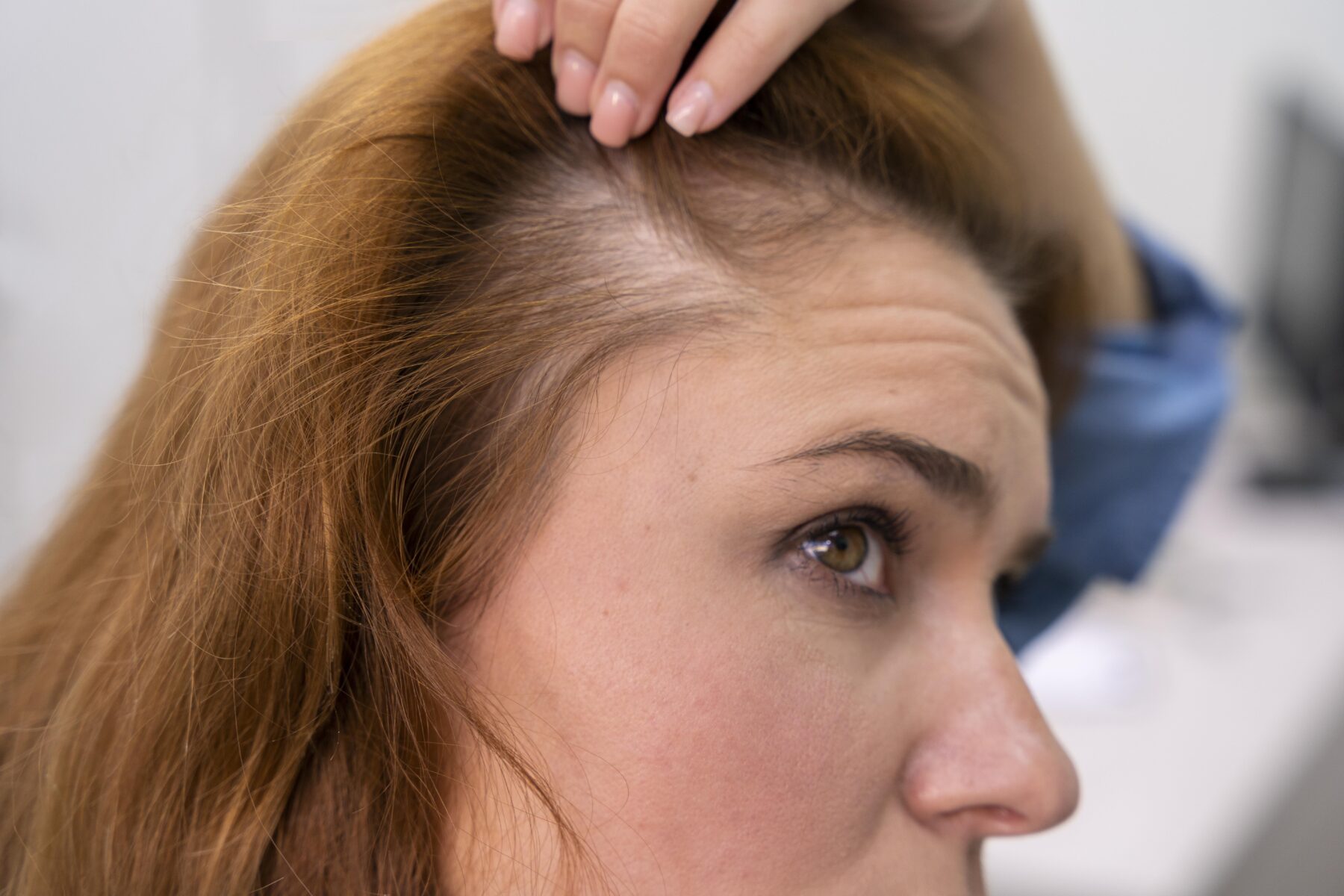 pérdida de cabello o densidad capilar